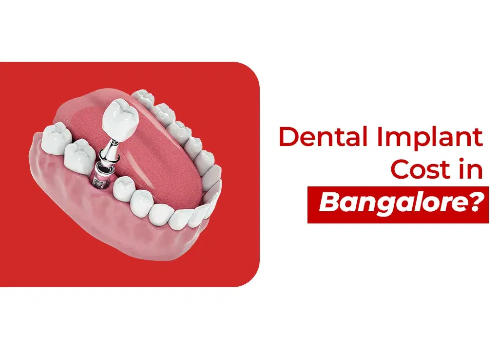 Dental Implant Cost in Bangalore