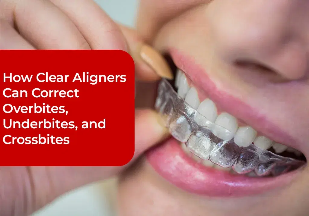 how-clear-aligners-can-correct-bites