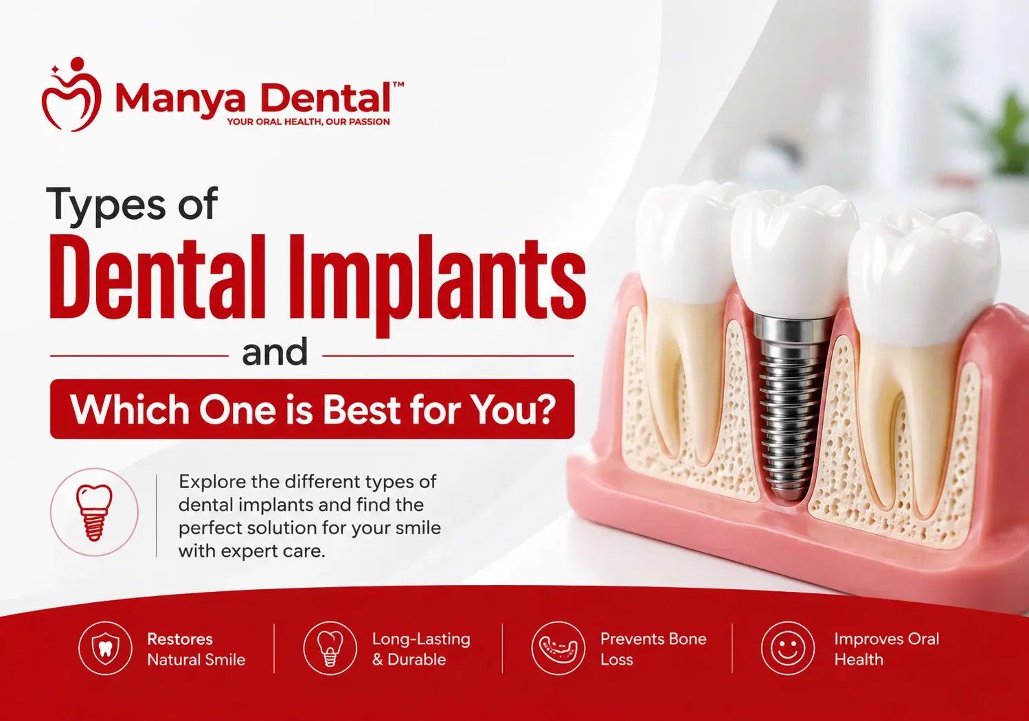 banner Types of Dental Implants and Which One is Best for You?
