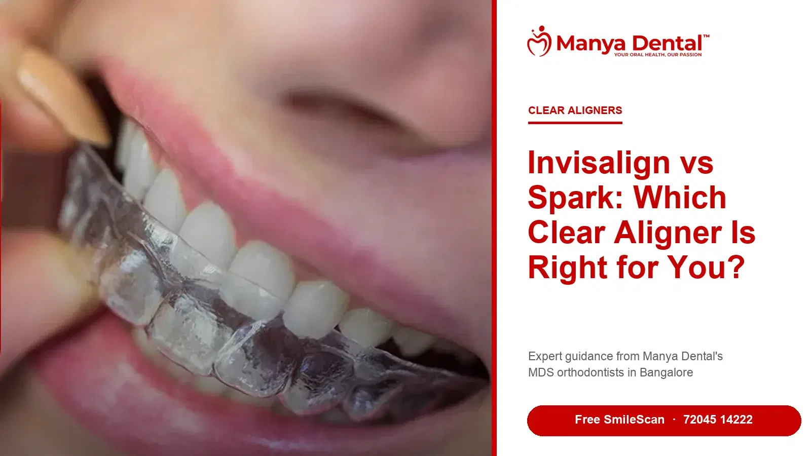 Invisalign vs Spark clear aligners